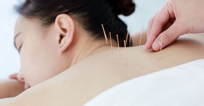 How Fertility Acupuncture Can Support Your Journey to Parenthood image